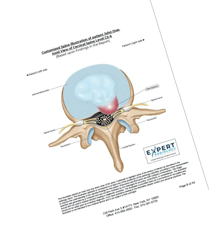 Expert Radiology cervical spine report with anatomical illustration