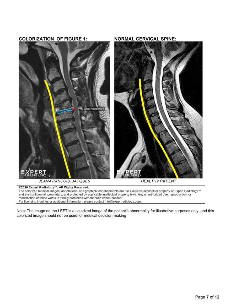 PrecisionPlus v3™ report — colorized key images with normal spine comparison