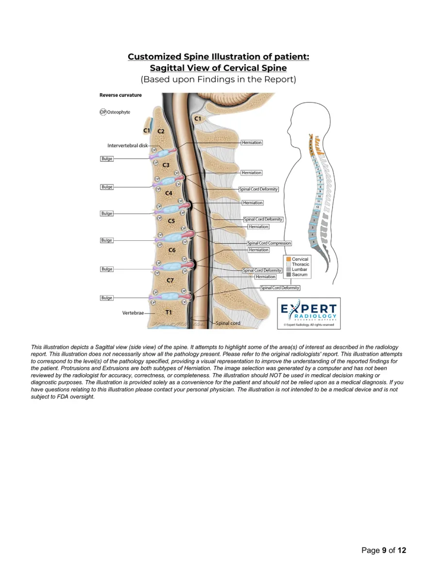 PrecisionPlus v3™ report page 9: Custom Sagittal Spine Illustration