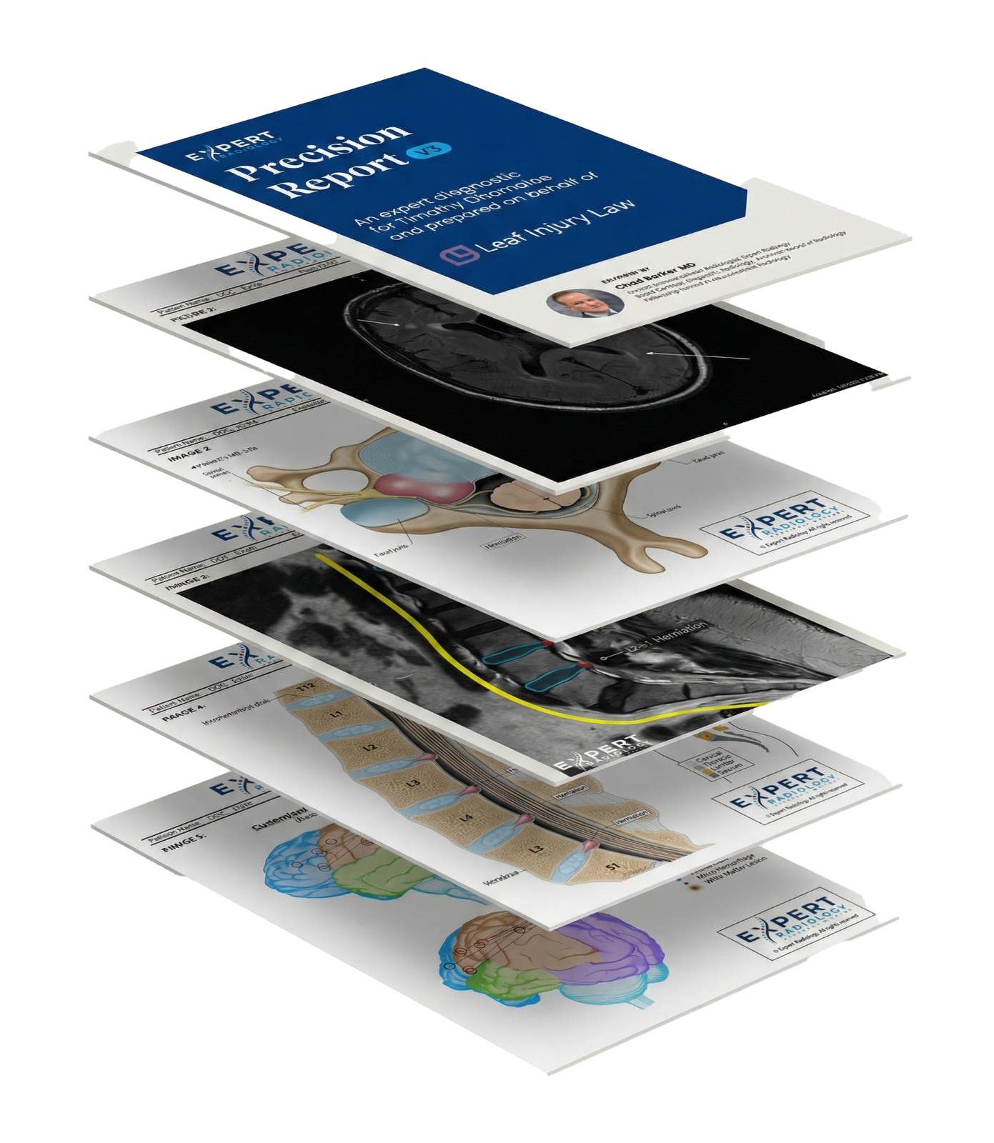 PrecisionPlus v3 stacked report pages showing various MRI visualizations and annotated medical imagery
